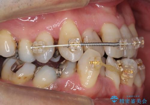 受け口 なんと部分矯正で治るんです!! インプラントを含めた総合歯科治療の治療中