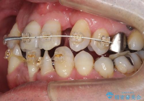 受け口 なんと部分矯正で治るんです!! インプラントを含めた総合歯科治療の治療中