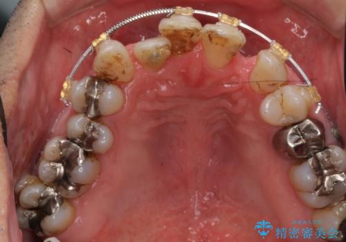 受け口 なんと部分矯正で治るんです!! インプラントを含めた総合歯科治療の治療中