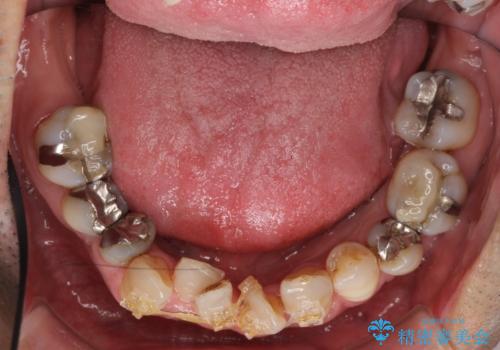受け口 なんと部分矯正で治るんです!! インプラントを含めた総合歯科治療の治療中