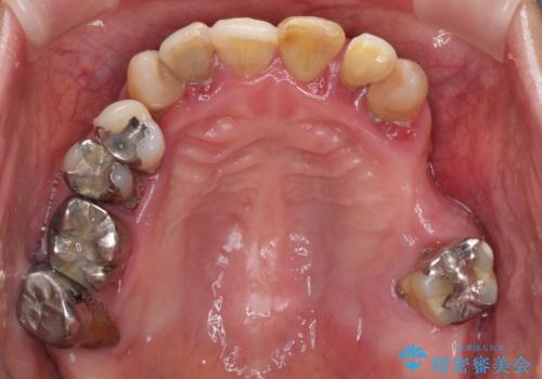歯周病で痛い 全顎的歯周病治療の治療前