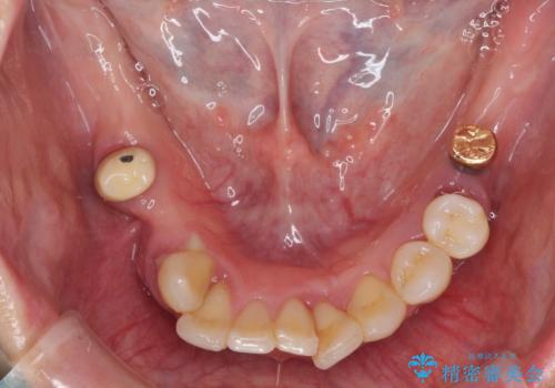 歯周病で痛い 全顎的歯周病治療の治療前