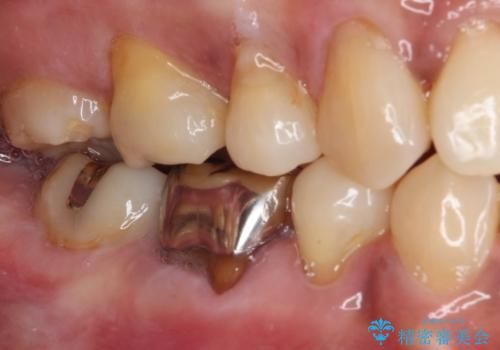奥歯の銀歯をゴールドに　の治療前