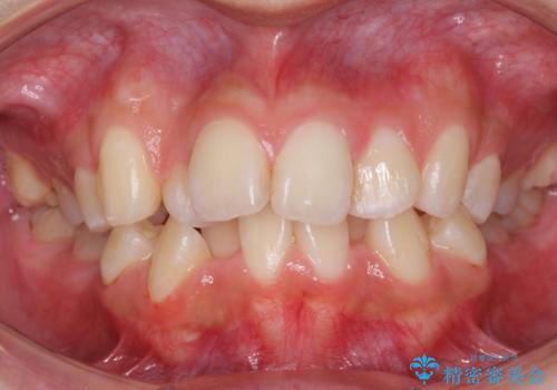 口元大事です! 見違える矯正!! 乱ぐい歯もあきらめないでください。の症例 治療前