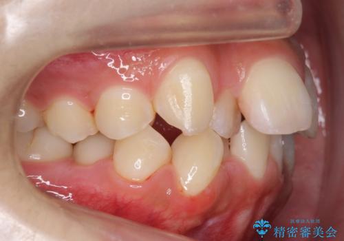 口元大事です! 見違える矯正!! 乱ぐい歯もあきらめないでください。の治療前