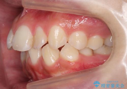 口元大事です! 見違える矯正!! 乱ぐい歯もあきらめないでください。の治療前