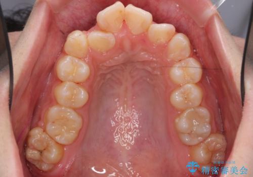 口元大事です! 見違える矯正!! 乱ぐい歯もあきらめないでください。の治療前