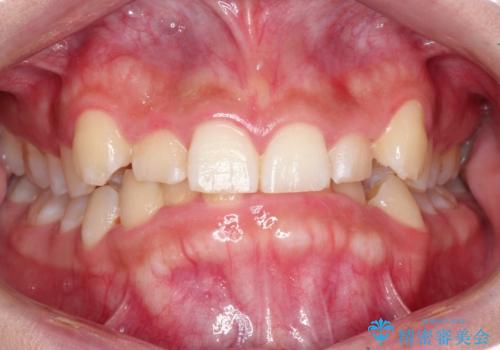 【審美ワイヤー】前歯が見えない。深い噛み合わせの治療の症例 治療前