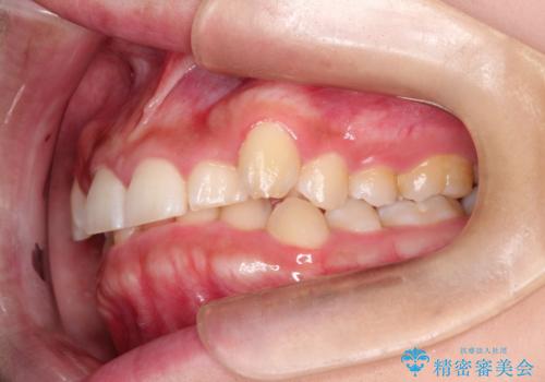 【審美ワイヤー】前歯が見えない。深い噛み合わせの治療の治療前