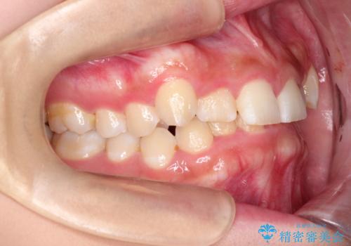 【審美ワイヤー】前歯が見えない。深い噛み合わせの治療の治療前