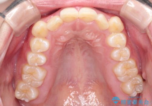 【審美ワイヤー】前歯が見えない。深い噛み合わせの治療の治療前