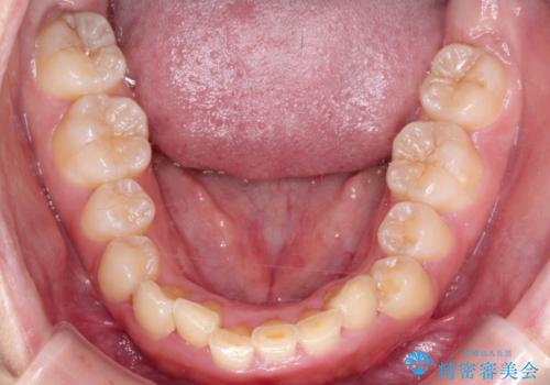 【審美ワイヤー】前歯が見えない。深い噛み合わせの治療の治療前