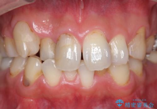 短期間で歯並びをきれいにしたい セラミックでかぶせる治療でも良いの症例 治療前
