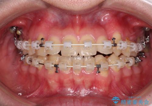 【モニター】1本欠損した下顎前歯と上顎の八重歯　ワイヤー装置で楽して矯正治療の治療中
