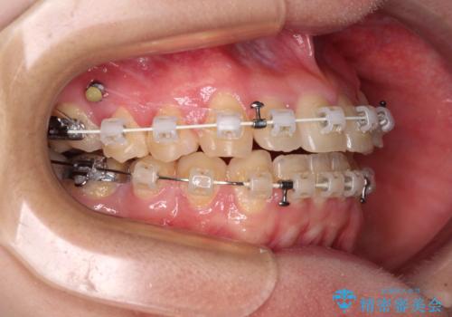 【モニター】1本欠損した下顎前歯と上顎の八重歯 ワイヤー装置で楽して矯正治療の治療中