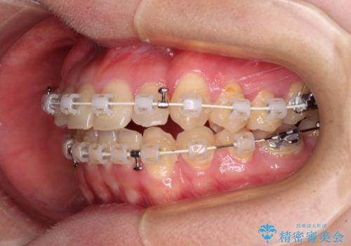 【モニター】1本欠損した下顎前歯と上顎の八重歯 ワイヤー装置で楽して矯正治療の治療中