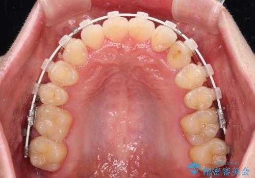【モニター】1本欠損した下顎前歯と上顎の八重歯 ワイヤー装置で楽して矯正治療の治療中