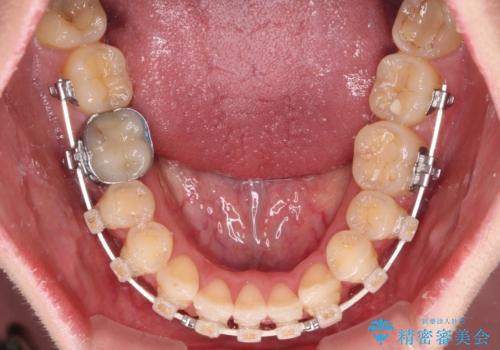 【モニター】1本欠損した下顎前歯と上顎の八重歯 ワイヤー装置で楽して矯正治療の治療中