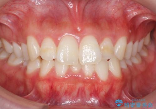 下の歯のがたつき　上より気になるの症例 治療前