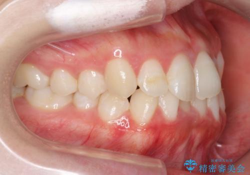 下の歯のがたつき 上より気になるの治療前