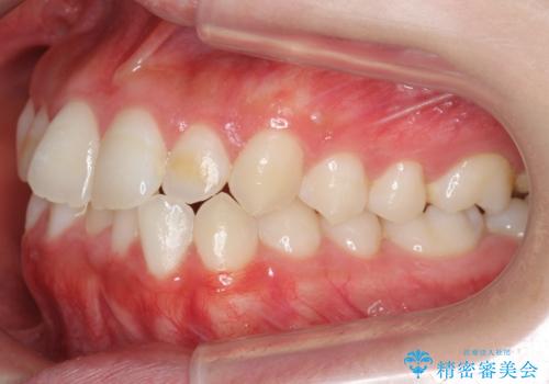下の歯のがたつき 上より気になるの治療前