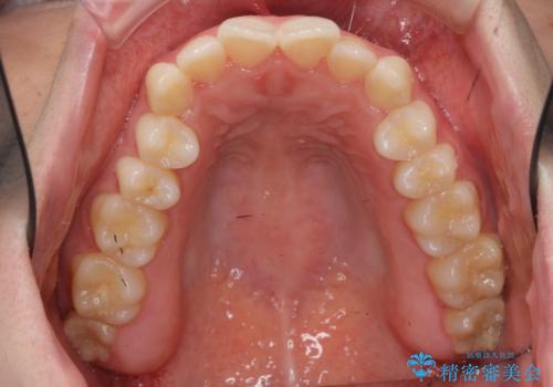 下の歯のがたつき 上より気になるの治療前