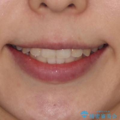 舌突出癖による開咬 舌のトレーニングを行いながら咬み合わせを改善の治療後(顔貌)