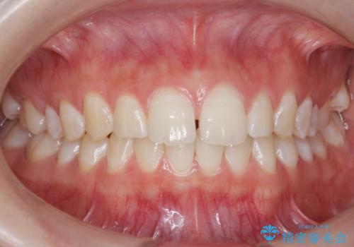 [ 正中離開の改善 ] マウスピース矯正で行う前歯の審美改善の症例 治療前