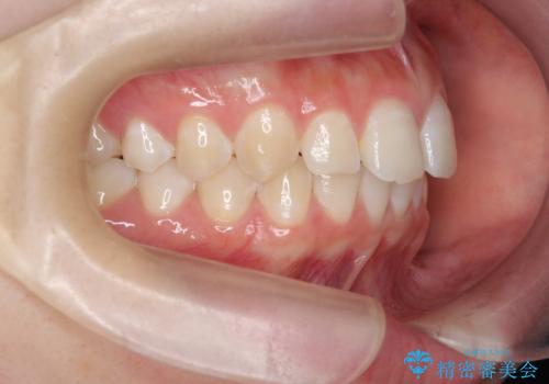 [ 正中離開の改善 ] マウスピース矯正で行う前歯の審美改善の治療前
