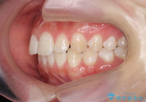[ 正中離開の改善 ] マウスピース矯正で行う前歯の審美改善の治療前