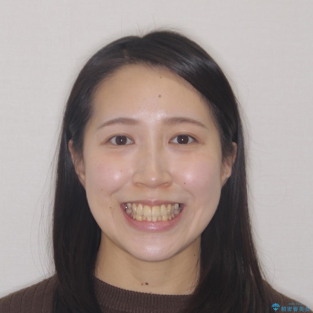 【モニター】急速拡大装置 狭い歯列を拡大してワイヤー装置で短期間治療の治療前(顔貌)