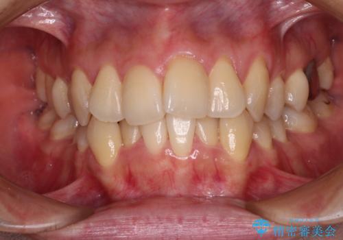 【モニター】急速拡大装置 狭い歯列を拡大してワイヤー装置で短期間治療の症例 治療前