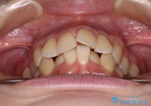 【モニター】急速拡大装置 狭い歯列を拡大してワイヤー装置で短期間治療の治療前