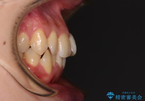 【モニター】急速拡大装置 狭い歯列を拡大してワイヤー装置で短期間治療の治療前