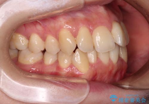 【モニター】急速拡大装置 狭い歯列を拡大してワイヤー装置で短期間治療の治療前