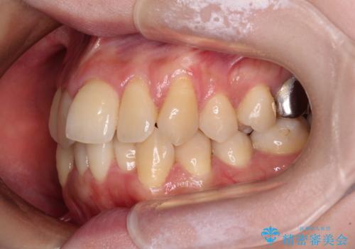 【モニター】急速拡大装置 狭い歯列を拡大してワイヤー装置で短期間治療の治療前