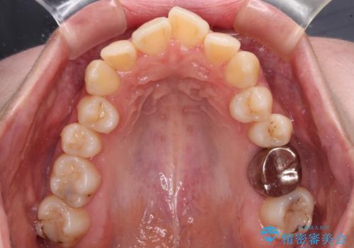 【モニター】急速拡大装置 狭い歯列を拡大してワイヤー装置で短期間治療の治療前