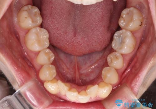 【モニター】急速拡大装置 狭い歯列を拡大してワイヤー装置で短期間治療の治療前