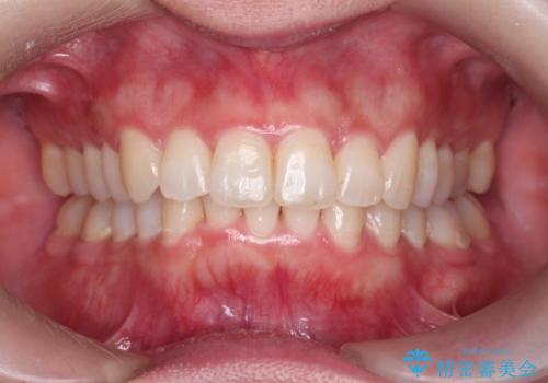 前歯をさげたい 歯を抜かずに マウスピース矯正で治したいの症例 治療後