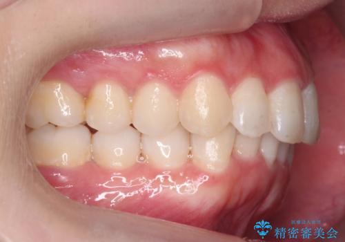 前歯をさげたい 歯を抜かずに マウスピース矯正で治したいの治療後
