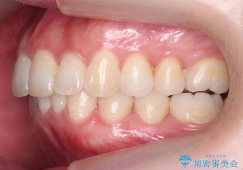 前歯をさげたい 歯を抜かずに マウスピース矯正で治したいの治療後