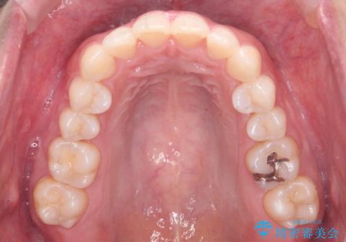 前歯をさげたい 歯を抜かずに マウスピース矯正で治したいの治療後