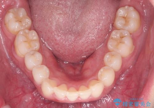 前歯をさげたい 歯を抜かずに マウスピース矯正で治したいの治療後