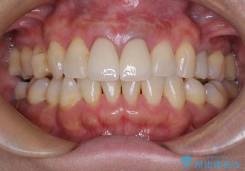 見栄えの悪い仮歯　前歯のオールセラミック治療の治療後