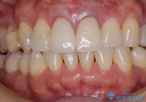 見栄えの悪い仮歯 前歯のオールセラミック治療の治療後