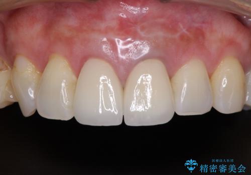 見栄えの悪い仮歯 前歯のオールセラミック治療の治療後
