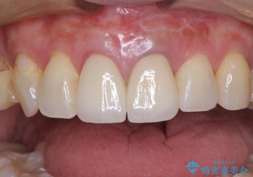 見栄えの悪い仮歯 前歯のオールセラミック治療の治療後