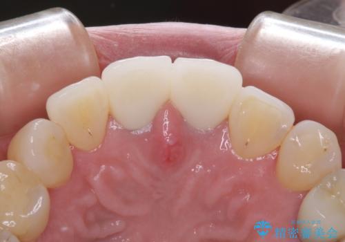 見栄えの悪い仮歯 前歯のオールセラミック治療の治療後