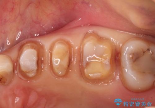 【オールセラミッククラウン】銀歯の下に大きな虫歯の治療中