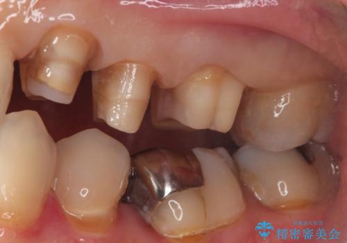 【オールセラミッククラン】銀歯の下に大きな虫歯の治療中